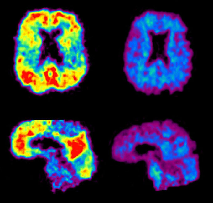 A vial of blood is put into a tube rack, with medical images of a brain in the background.